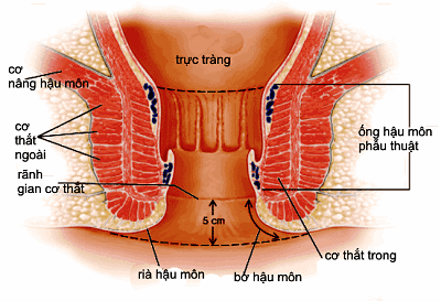 búi trĩ