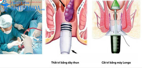 Chữa bệnh trĩ tại hà nội chữa bệnh trĩ ở tphcm